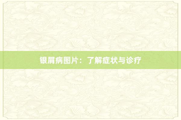 银屑病图片：了解症状与诊疗